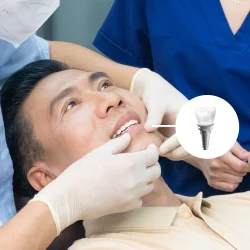 Trong-rang-Implant-2 (1)